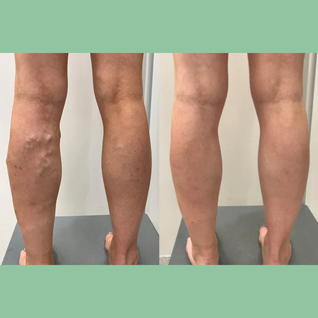 Lymphora™ – Natürliche Linderung von Schwellungen