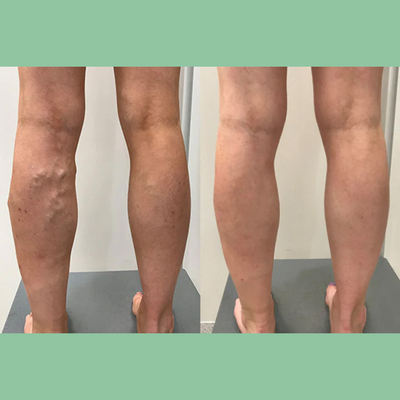 Lymphora™ – Natürliche Linderung von Schwellungen