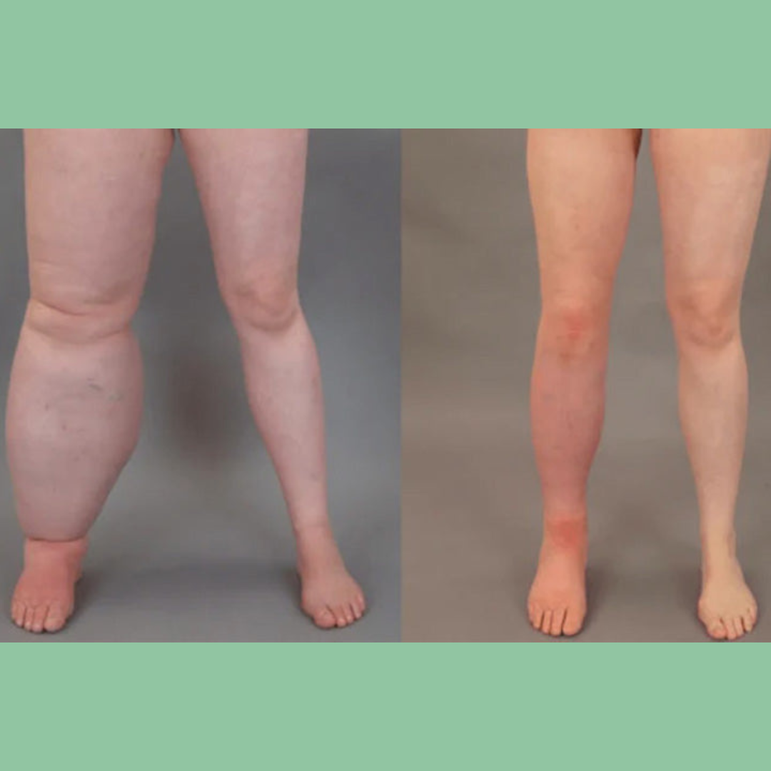 Lymphora™ – Natürliche Linderung von Schwellungen