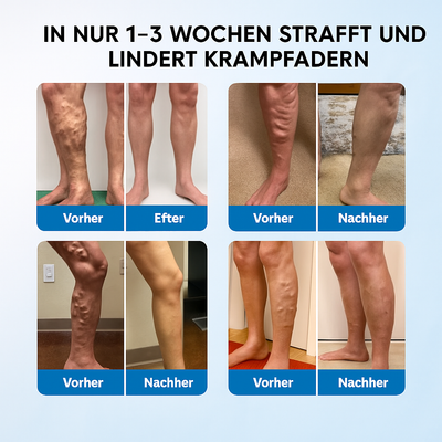 Varicell™ –Revolutionäre Linderung von Krampfadern