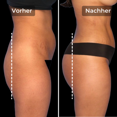 CoreLift™ – EMS-Shorts zum Formen und Straffen