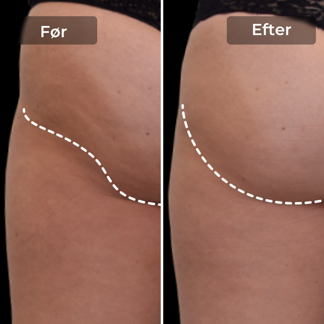 CoreLift™ – EMS-Shorts zum Formen und Straffen