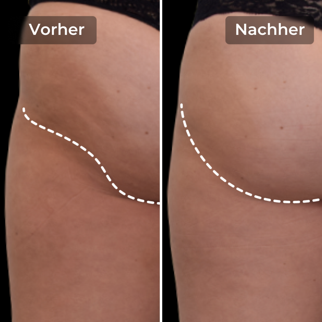 CoreLift™ – EMS-Shorts zum Formen und Straffen