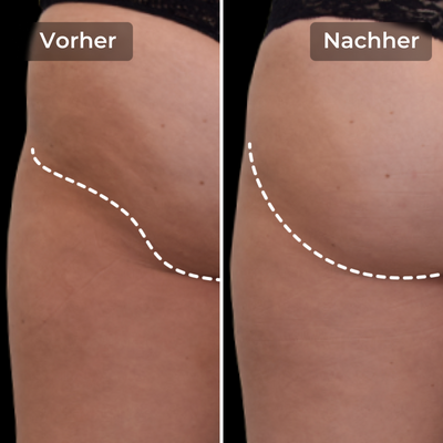 CoreLift™ – EMS-Shorts zum Formen und Straffen