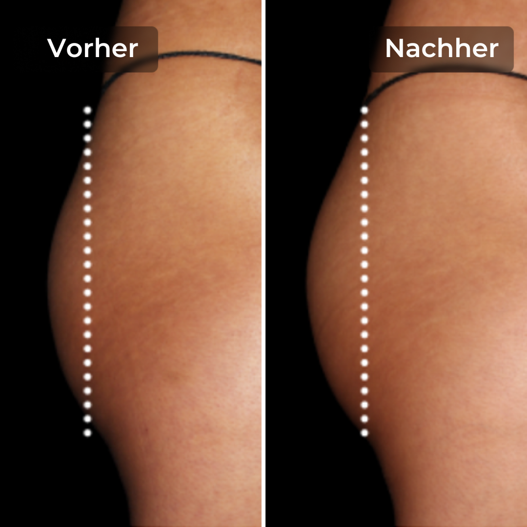 CoreLift™ – EMS-Shorts zum Formen und Straffen