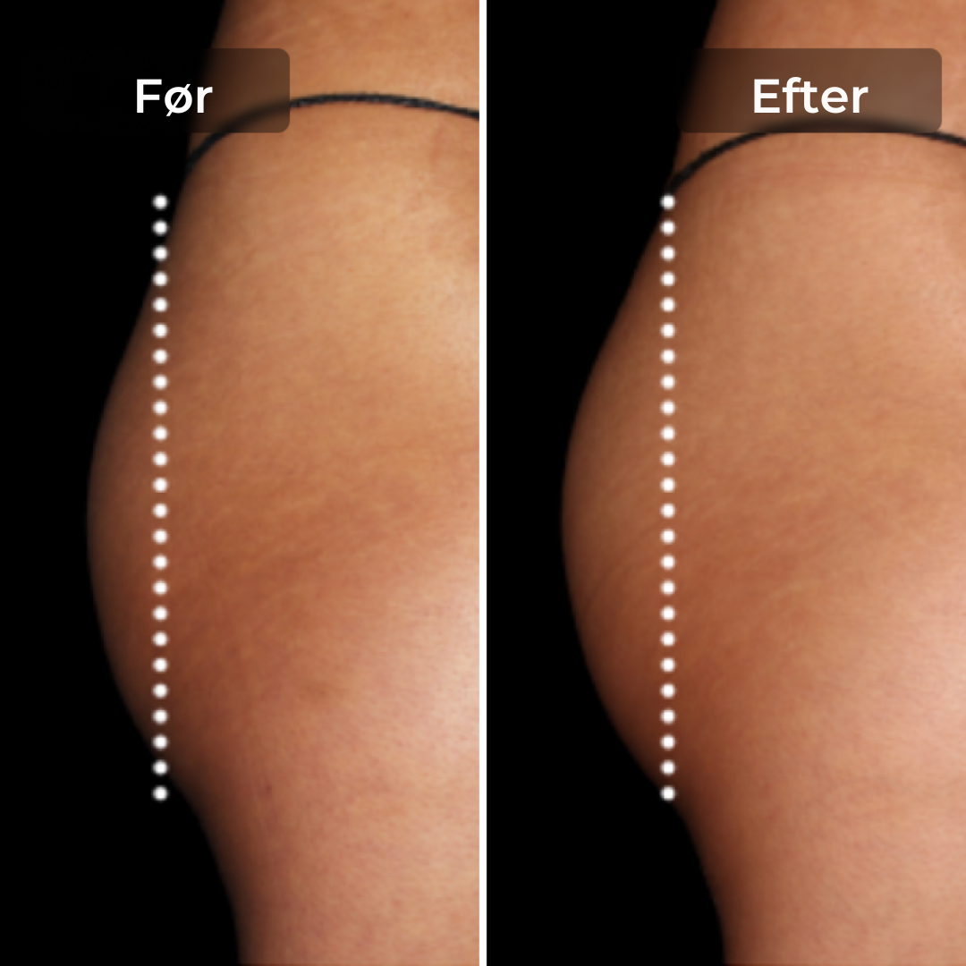 CoreLift™ – EMS-Shorts zum Formen und Straffen