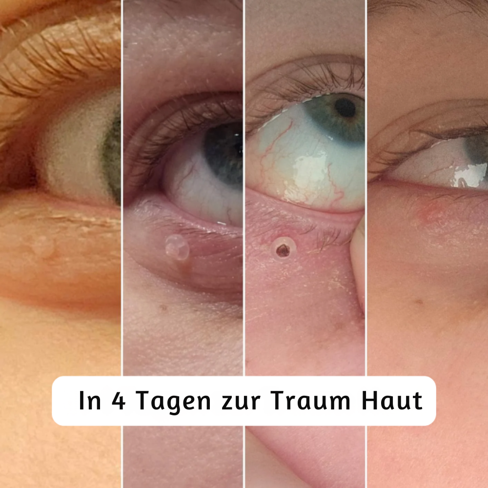 DermaLoop™ – Schmerzfreier Hautanhängsel-Entferner