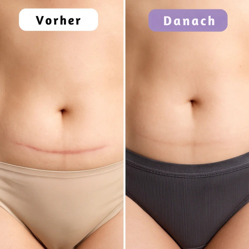 EpiSilk™ – Sanftes Hautpflaster zur Narbenpflege