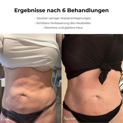 GlideSculpt™ - 5-Minuten Cellulite-Massagegerät