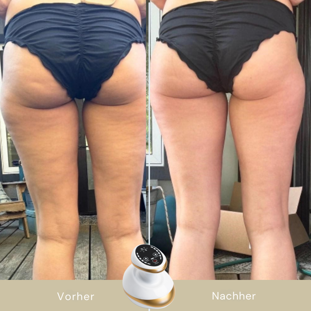 GlideSculpt™ - 5-Minuten Cellulite-Massagegerät