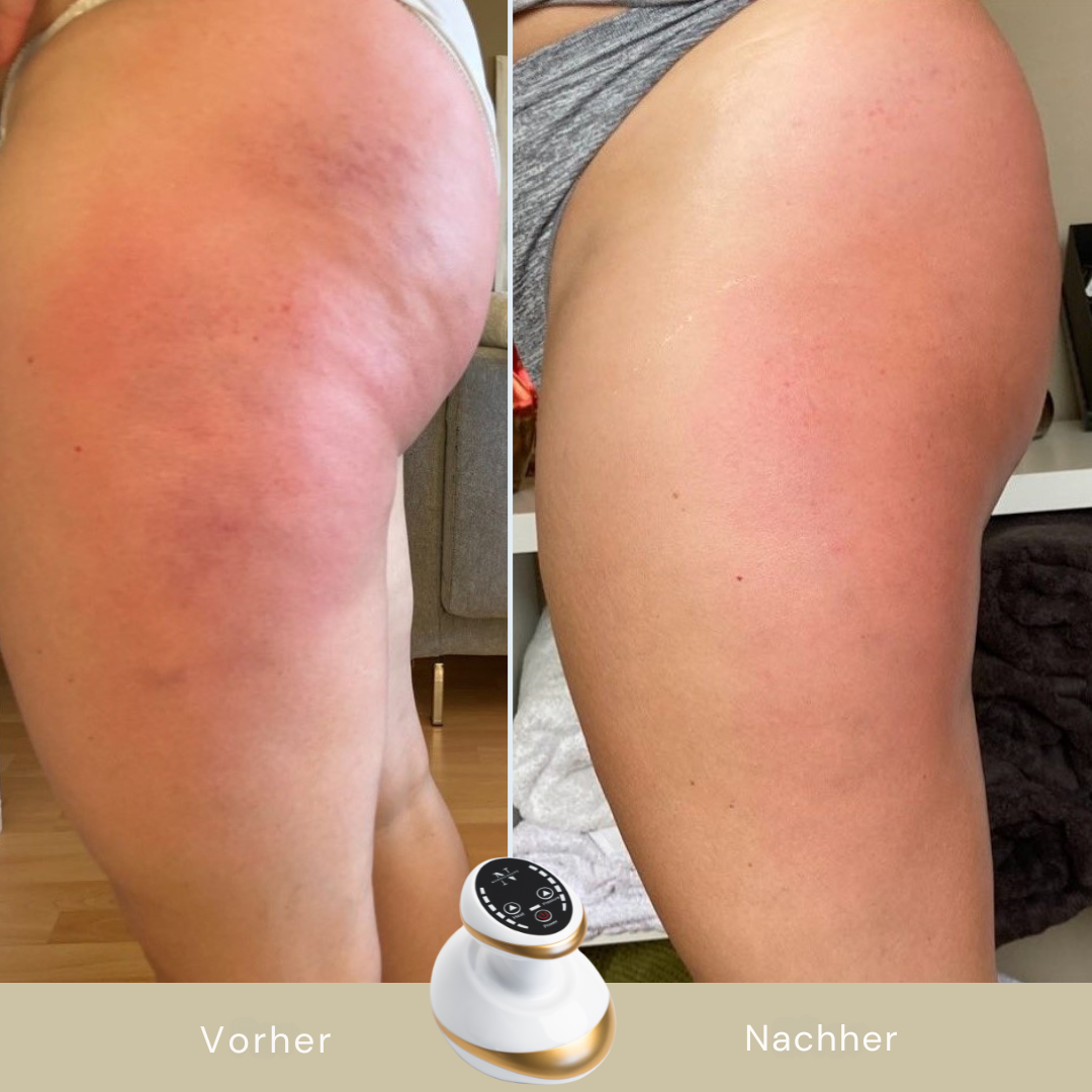 GlideSculpt™ - 5-Minuten Cellulite-Massagegerät