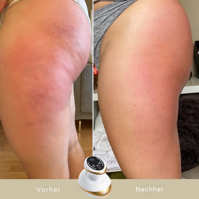 GlideSculpt™ - 5-Minuten Cellulite-Massagegerät