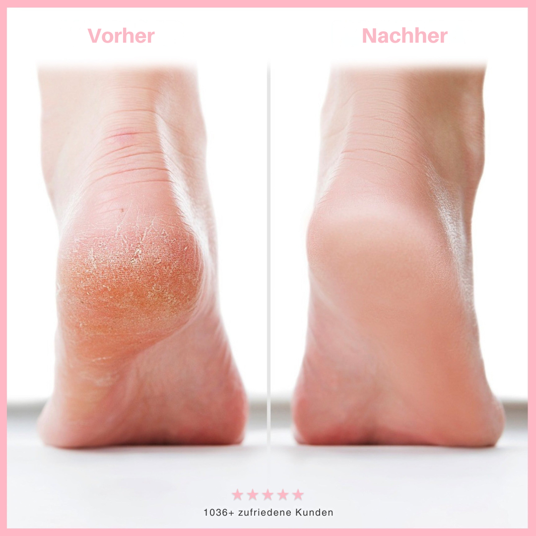 HeelGlow™ – Lösung zur Reparatur Rissiger Fersen