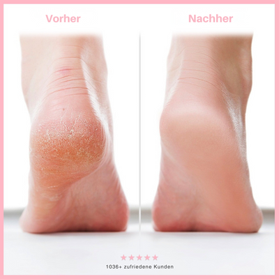 HeelGlow™ – Lösung zur Reparatur Rissiger Fersen